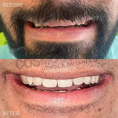 Tooth-colored dental veneer illustration