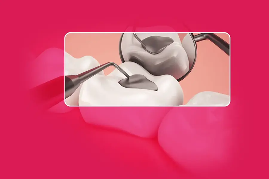 Dental Composite Fillings in Gurgaon