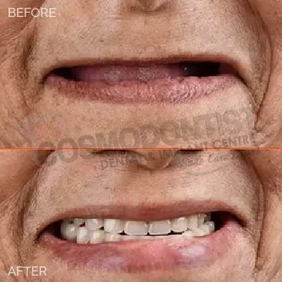 veneers