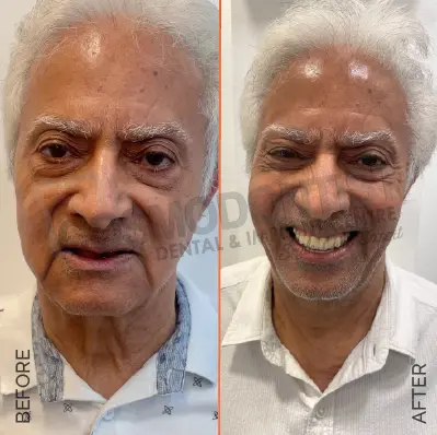 Porcelain Veneers