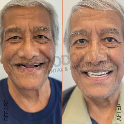 Composite Resin Veneers