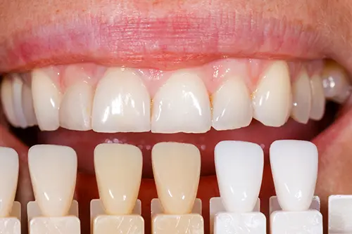 Composite Resin Veneers