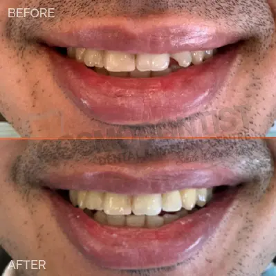 veneers