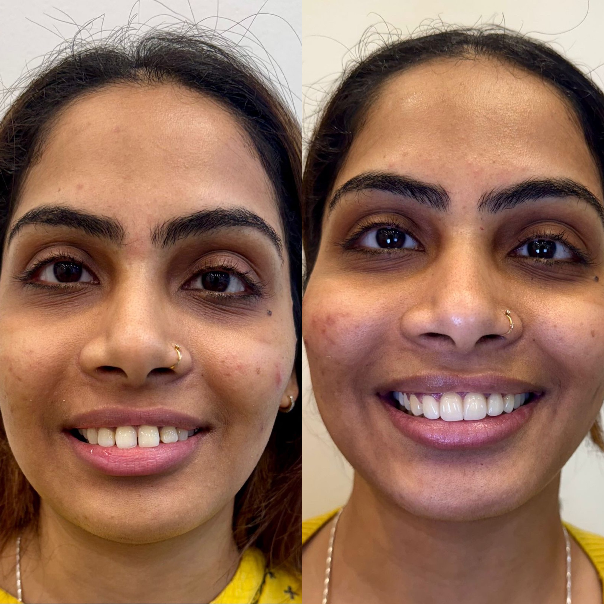 Dental Veneers Treatment in Gurgaon Before and after