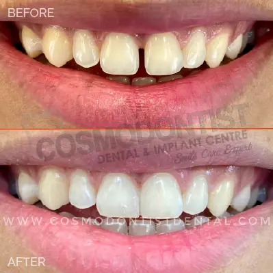 Porcelain Veneers