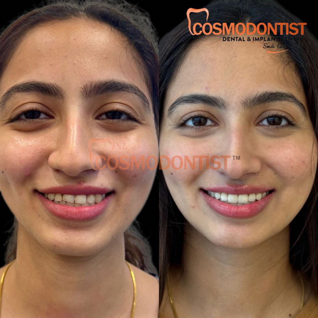 Dental Veneers Treatment in Gurgaon Before and after