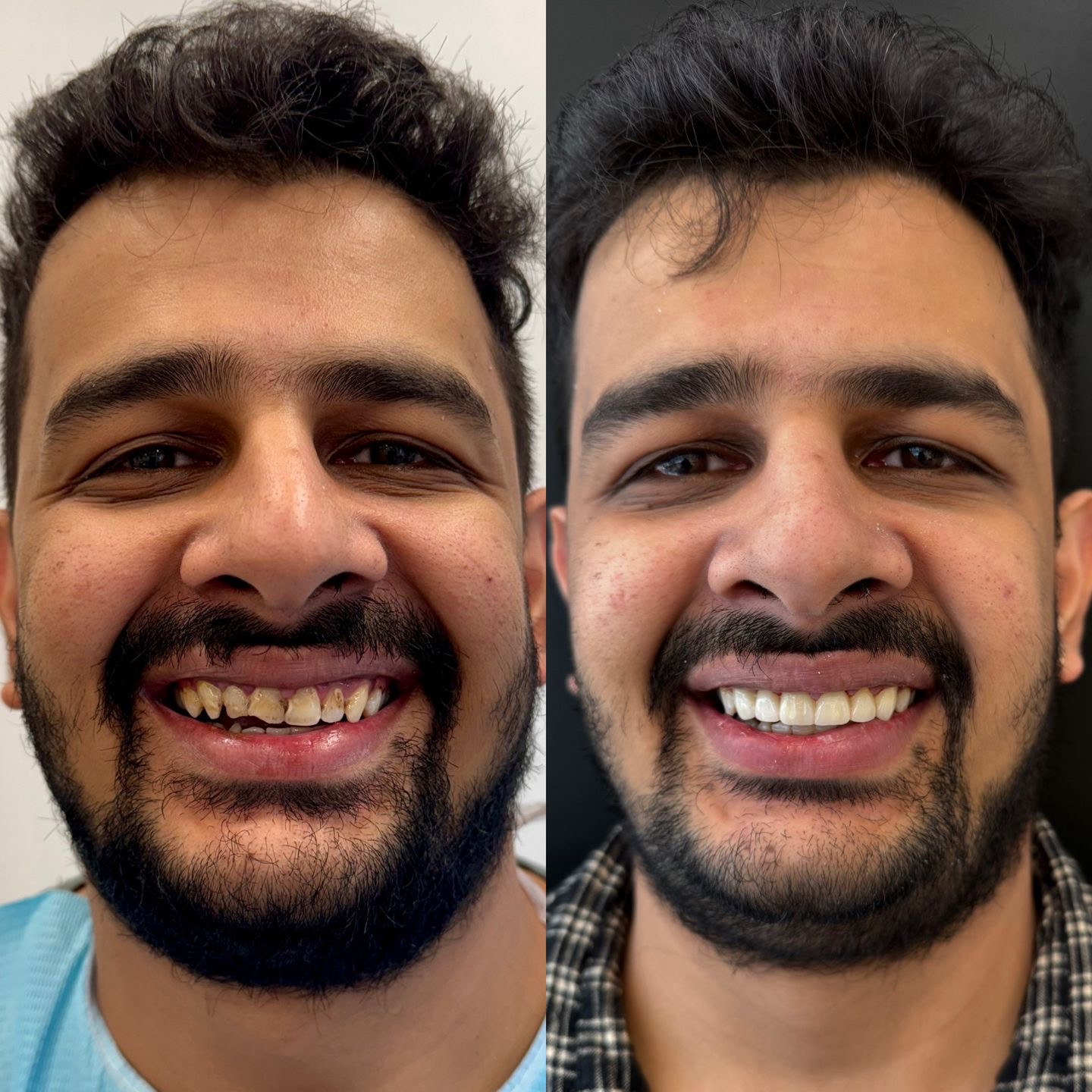 Dental Veneers Treatment in Gurgaon Before and after