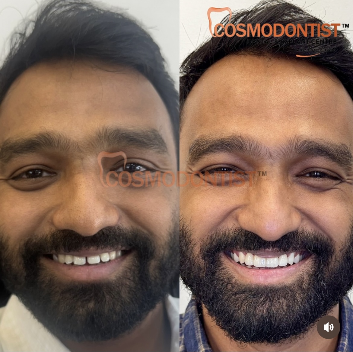 Dental Veneers Treatment in Gurgaon Before and after