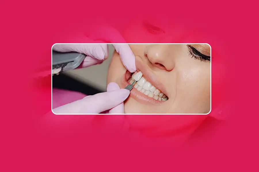 Dental Veneers in Gurgaon