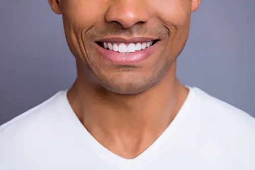 Porcelain Veneers