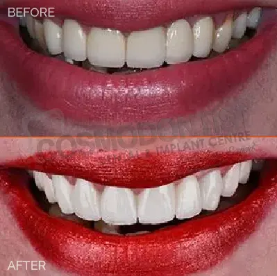 Instant Teeth Whitening Treatment