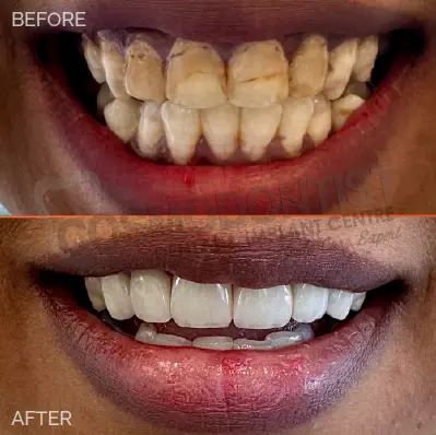 Instant Teeth Whitening Treatment