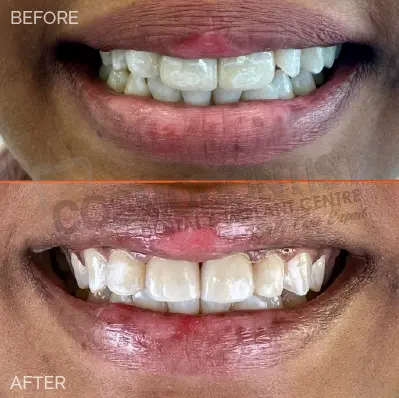Instant Teeth Whitening Treatment