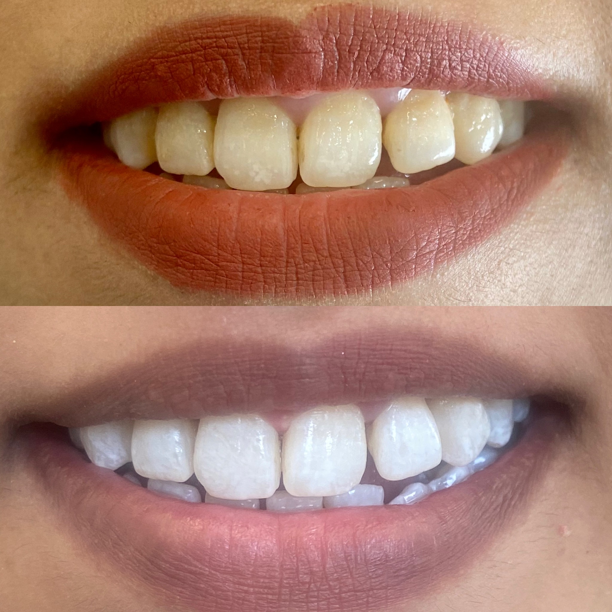 Instant Teeth Whitening Treatment