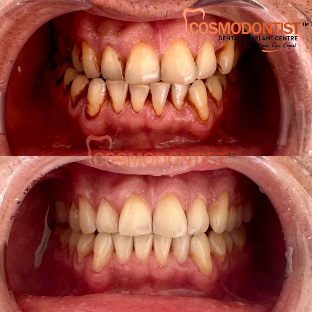 Instant Teeth Whitening Treatment