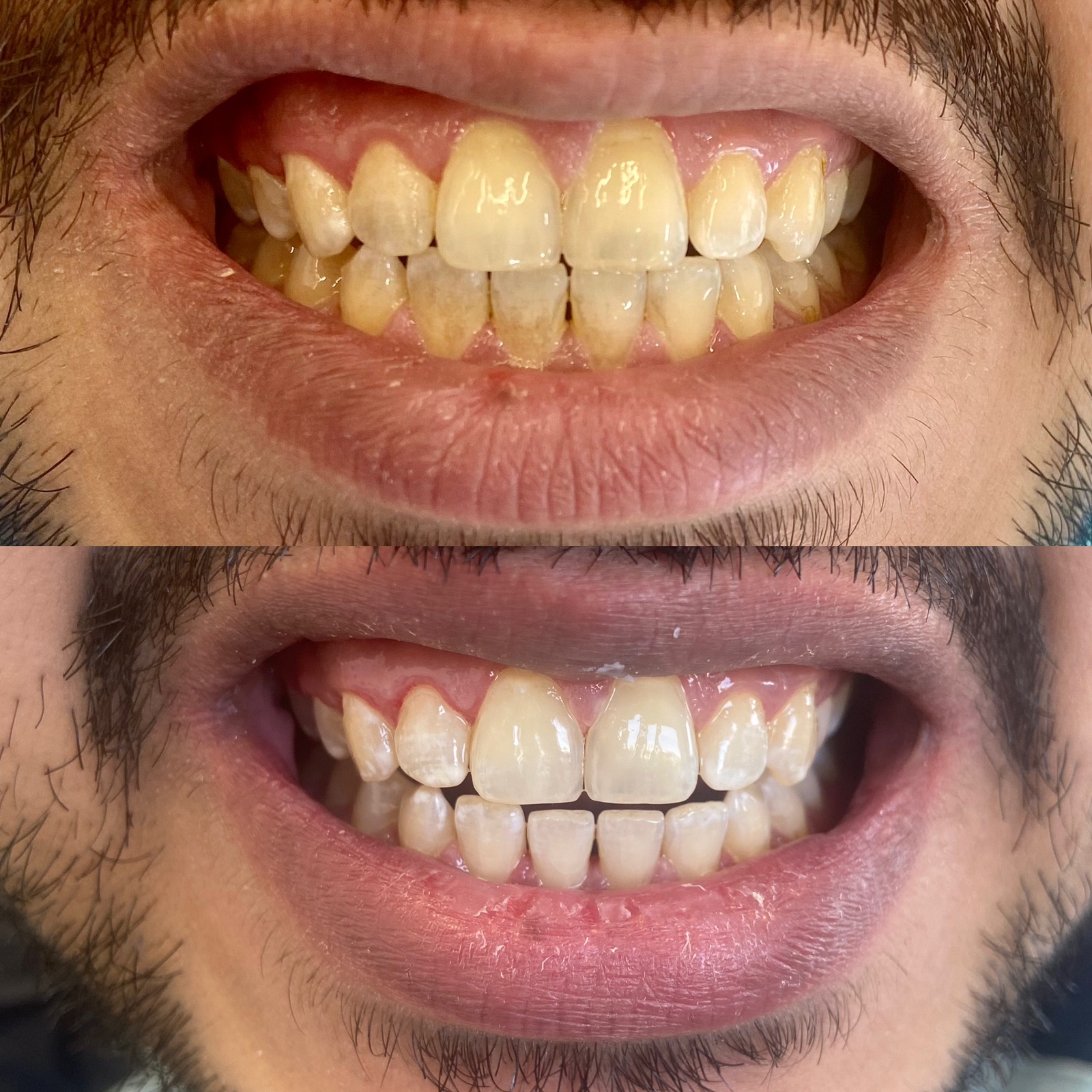 Instant Teeth Whitening Treatment