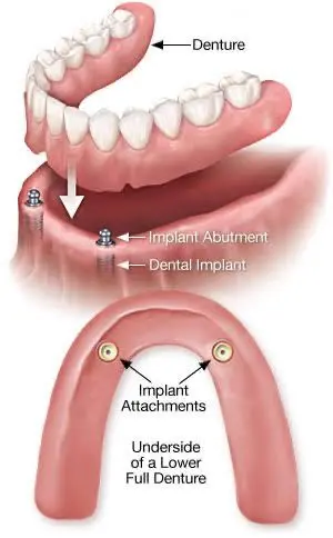 implants attachments