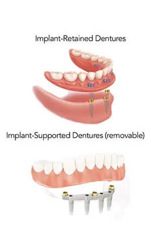 implanted retained dentures