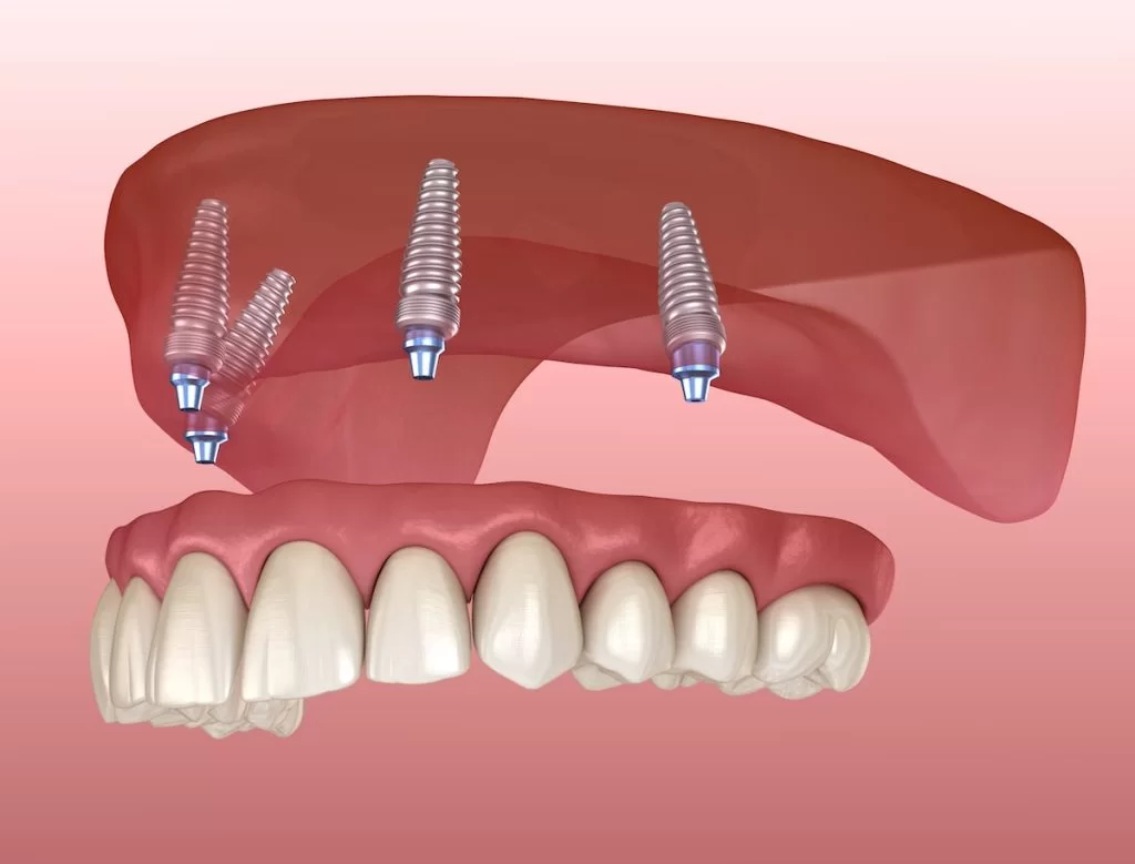 Dental Implant Treatment in Gurgaon